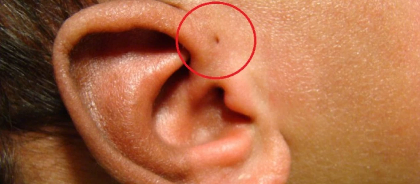 Προωτικός κολπίσκος: Τι είναι η μικροσκοπική τρύπα που έχουν κάποιοι πάνω από το αυτί;